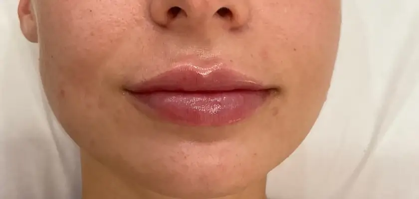 Lip Filler After