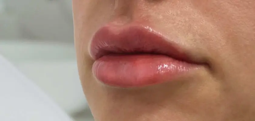 Lip Filler After