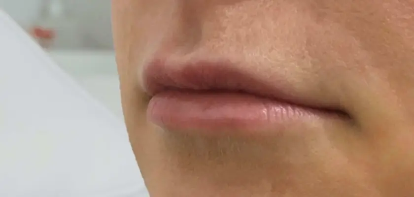Lip Filler Before