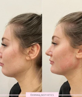 Dermal Filler