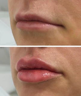 Lip Filler