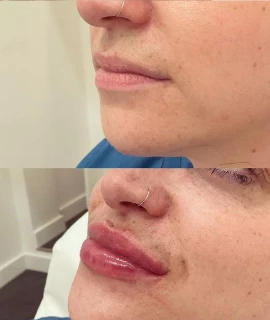 Lip Filler